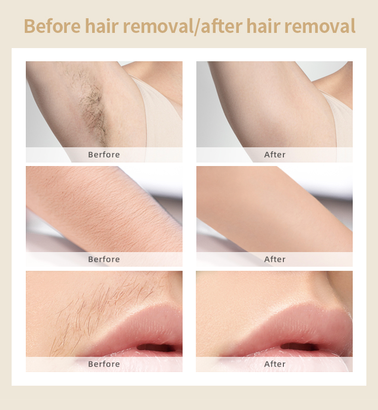 IPL Laser Hair Removal At Home Handset